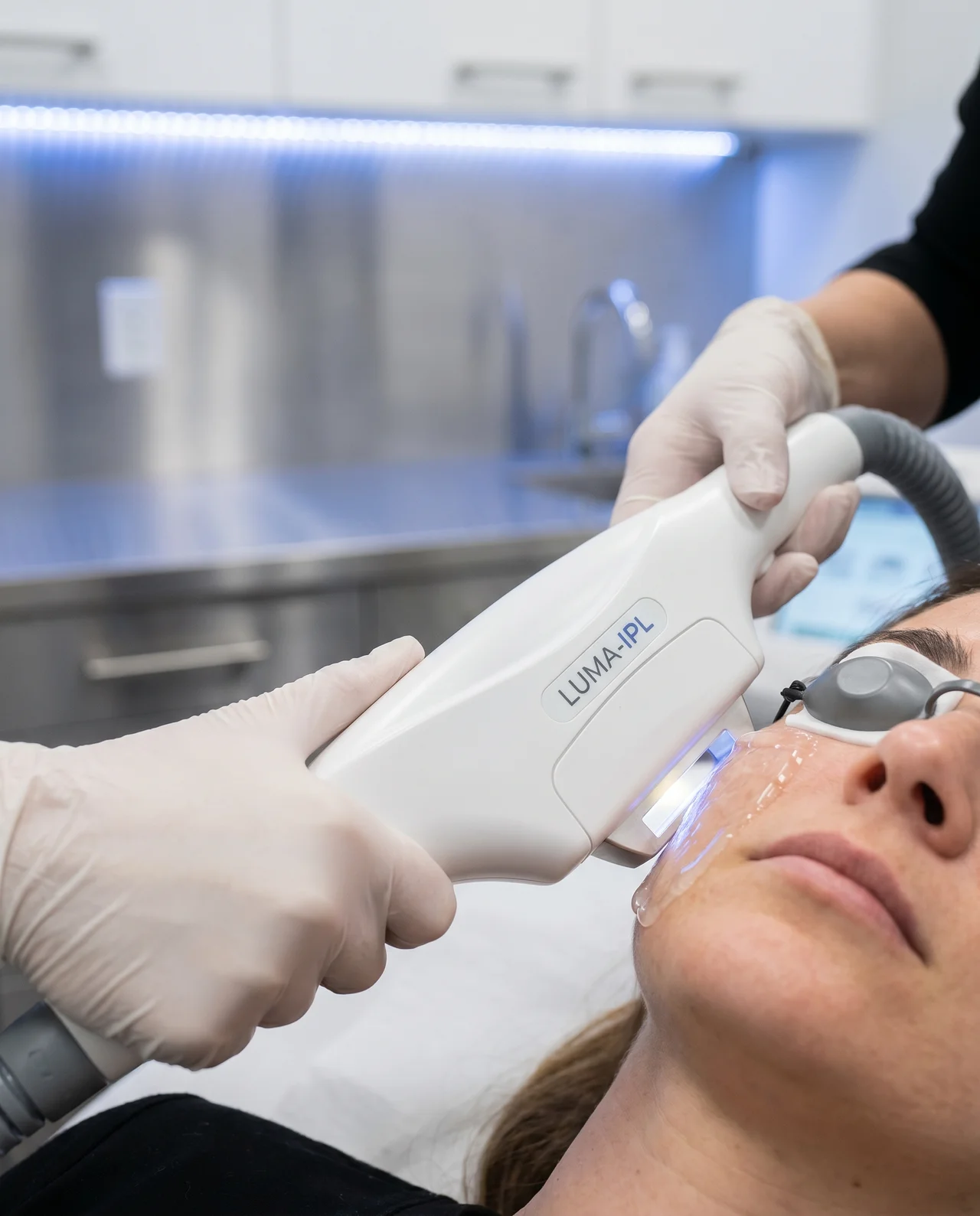 IPL Photofacial at Med Spa Myrtle Beach